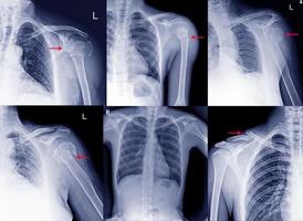 Collection Film x ray shoulder radiograph show shoulder dislocation and bone brokenus from accident Highlight on arrow point. Medical imaging concept. photo