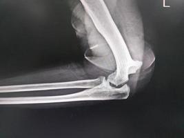 Elbow joint dislocation  x-ray image.