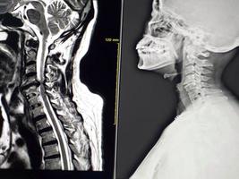 MRI Cervical-spine Shows C4-C5 Moderate spinal cord compression photo