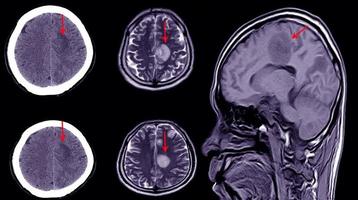 Tomografía computarizada del cerebro de un paciente con antecedentes de traumatismo craneoencefálico leve que muestra un gran hematoma subdural subagudo foto