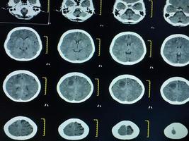 CT Brain History Headache Finding mass with ill-defined margin and surrounding edema photo