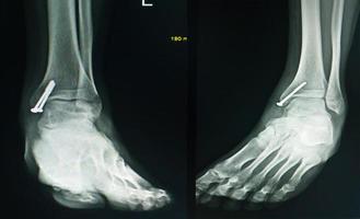 X-ray foot after operation fix screws in medial malleolus tibia. photo