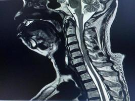 resonancia magnética de la columna cervical muestra compresión moderada de la médula espinal c4-c5 foto