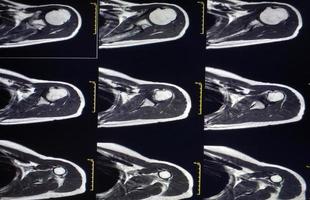 Magnetic resonance imaging of Shoulder Joint photo