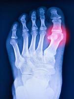 X-ray foot and arthritis at metatarsophalangeal joint . photo