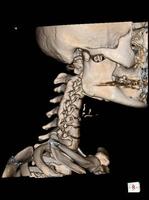 CT Scan cervical spine 3 D render . photo