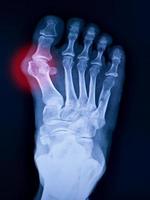 pie de rayos x y artritis en la articulación metatarsofalángica foto