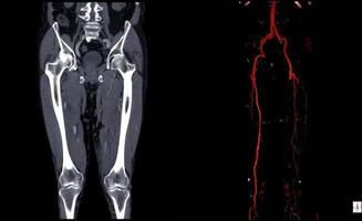 Computed tomography angiography  CT angiography or CTA of lower extremities photo