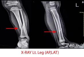 X-ray Left Leg AP Lat fracture Tibia. photo