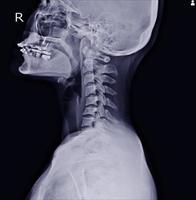 x-ray cervical spine photo