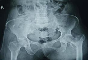 A pelvic x-ray showing closed fracture of intertrochanter of femur with displacement photo