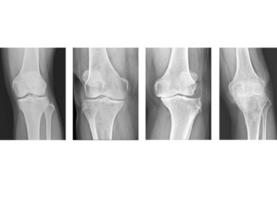 Osteoarthritis knee . film x-ray photo