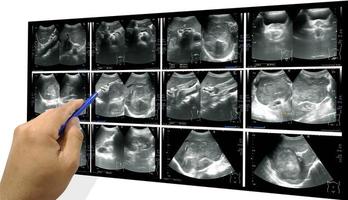 Ultrasound whole abdomen photo