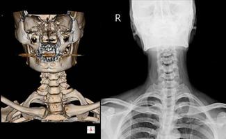 tomografía computarizada de la columna cervical 3 d render y radiografía de la columna cervical. foto