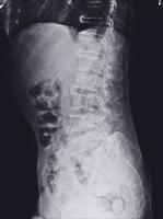 X-ray lumbar spine finding Multiple hyperdensity and hypodensity bone lesions at both iliac bones. photo