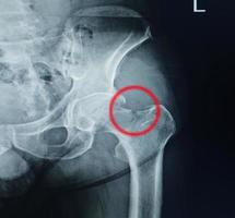 A pelvic x-ray showing closed fracture of intertrochanter of femur with displacement. The patient has hip pain and needs reduction with internal fixation. photo