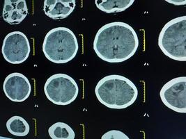 CT Brain History Headache Finding mass with ill-defined margin and surrounding edema photo