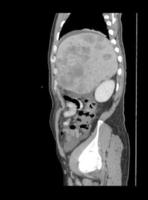 TC de abdomen completo encontrando colangiocarcinoma, foto