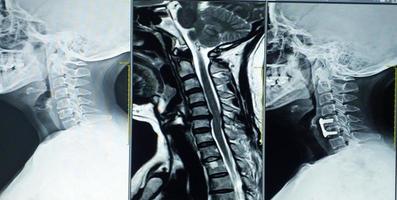 MRI Cervical-spine Shows C4-C5 Moderate spinal cord compression photo