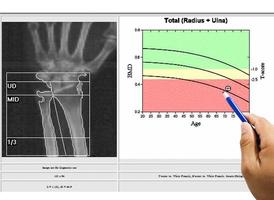 special examination medical image wrist bone density on white background. photo