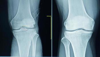 película de rayos X de las articulaciones y ligamentos normales de la rodilla humana concepto de imagen médica. foto