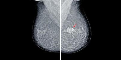 Mammogram radio imaging for breast cancer diagnosis photo