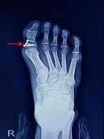fractura de pie de rayos x falang proximal y cirugía arreglar mini placa y tornillos foto