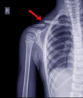 Chest x-ray fracture right clavicle. photo