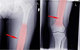Knee joint.No fracture, dislocation , bony destruction . photo