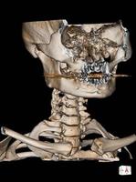 CT Scan cervical spine 3 D render . photo