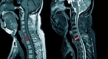 resonancia magnética de la columna cervical foto