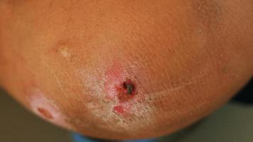 The abrasion wound is infected with flies and unclean diseases. photo