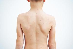 Young boy having chickenpox pictures of skin photo