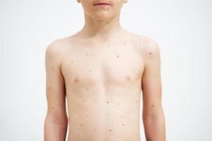 Young boy having chickenpox pictures of skin photo