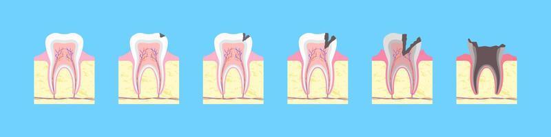 proceso de destrucción cariosa del diente. formación de hueso saludable con fisura negra e inflamación gradual. deterioro del esmalte con infección dental y pérdida completa del vector