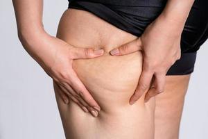 Woman showing cellulite on legs like orange peel skin The concept of treatment and elimination of excess weight. photo