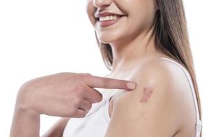 Woman showing COVID 19 vaccine skin irritation scar. Scars removal concept, close up, selective focus photo