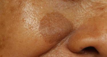 Small brown patches called age spots on face of Asian elderly woman. They are also called liver spots, senile lentigo, or sun spots. Wrinkles around closed eye of Asian elder woman. Closeup view photo
