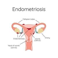 Endometriosis. The appearance of the disease endometriosis. Endometrium. Infographic vector