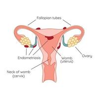 Endometriosis. The appearance of the disease endometriosis. Endometrium. Infographic vector
