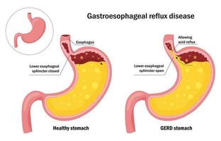 Healthy stomach and gastroesophageal reflux disease infographic vector