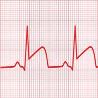 depicts ECGs for myocardial infarction. Heart attack sign. coronary artery thrombosis symbol. flat style. vector