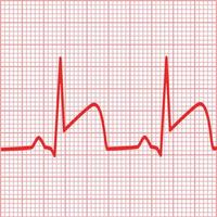 representa ecgs para infarto de miocardio. señal de ataque al corazón. símbolo de trombosis de la arteria coronaria. estilo plano vector