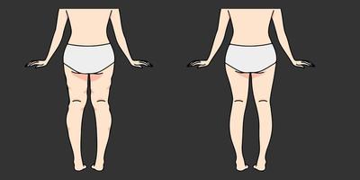Cellulite removal, Before and after cellulite removal vector