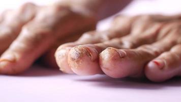 close-up das unhas dos pés infectadas da mulher video