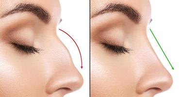 comparación de la nariz femenina antes y después de la cirugía plástica foto