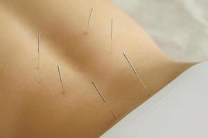 Female back with steel needles during procedure of acupuncture therapy photo