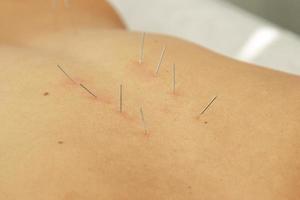 Female back with steel needles during procedure of acupuncture therapy photo