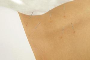 espalda femenina con agujas de acero durante el procedimiento de terapia de acupuntura foto