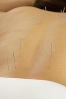 Female back with steel needles during procedure of acupuncture therapy photo